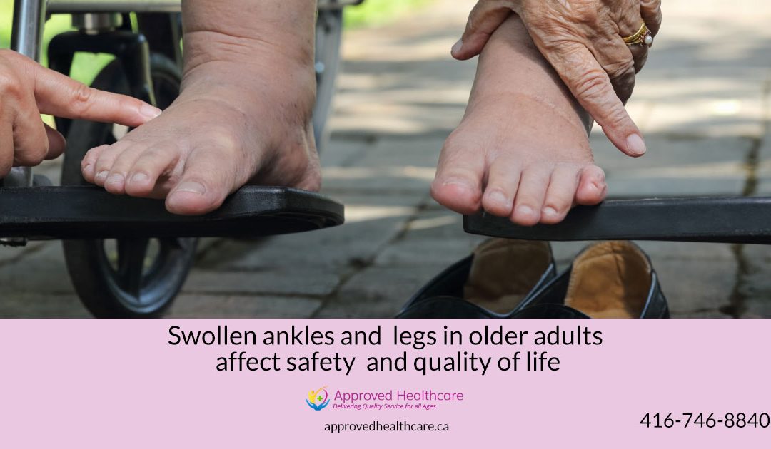Swollen Ankles in Elderly: Causes and Simple Home Exercises for Relief